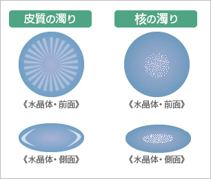 皮質の濁り、核の濁り